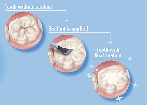 dental sealants drawing