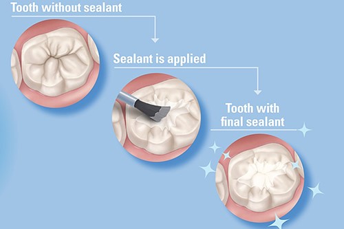 Dental Sealant Drawing PDF