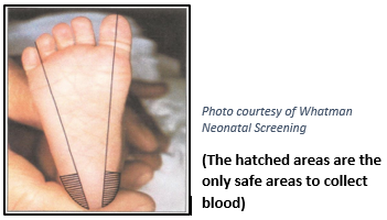 baby's foot with cross-hatching showing where it is safe to perform heel stick blood spot test