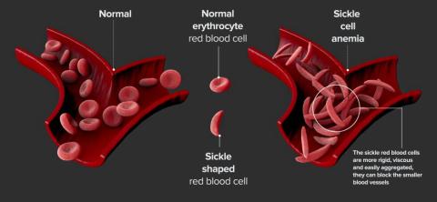 Sickle cell illustration